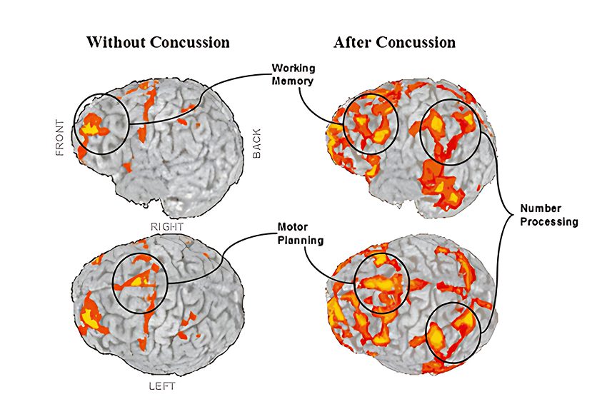 Neuroinflammation
