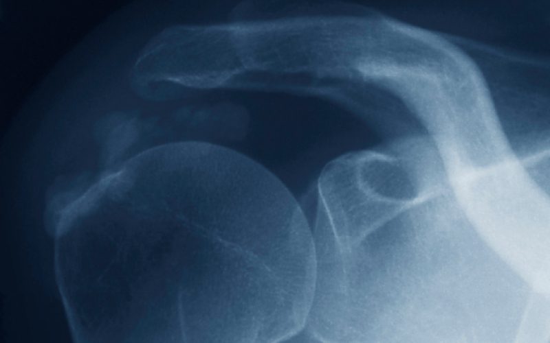 Shoulder arthroscopy diagnosis.