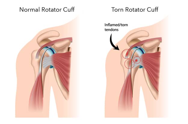 Rotator Cuff