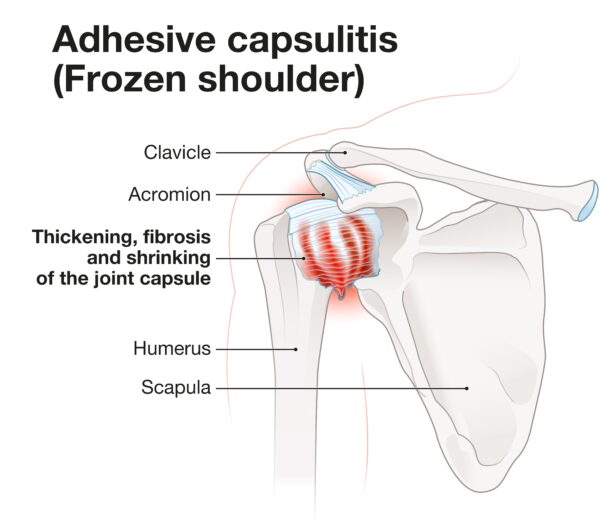 Adhesive Capsulitis or Frozen Shoulder