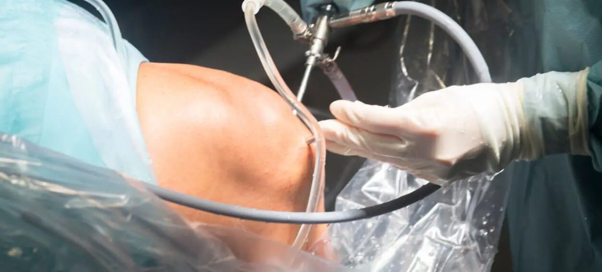 Arthroscopy Surgery